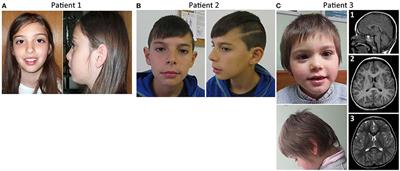 The Role of AKT3 Copy Number Changes in Brain Abnormalities and Neurodevelopmental Disorders: Four New Cases and Literature Review